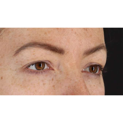 Blepharoplasty (Eyelid Surgery) Before & After Patient #10771