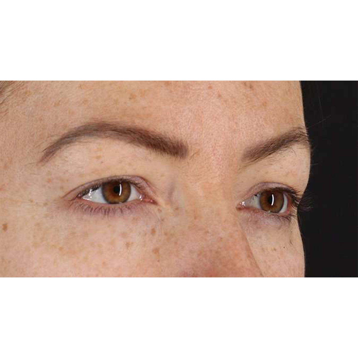 Blepharoplasty (Eyelid Surgery) Before & After Patient #10771