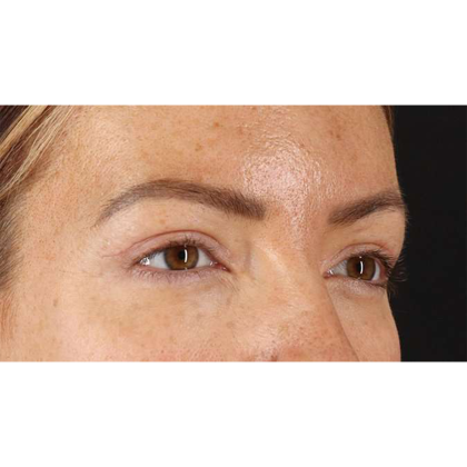 Blepharoplasty (Eyelid Surgery) Before & After Patient #10771