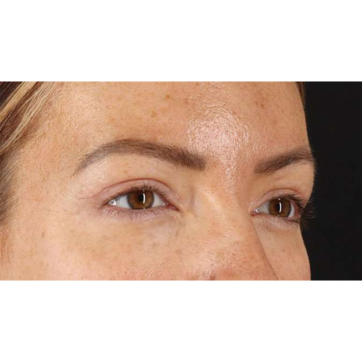 Blepharoplasty (Eyelid Surgery) Before & After Patient #10771