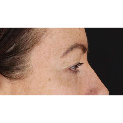 Blepharoplasty (Eyelid Surgery) Before & After Patient #10771