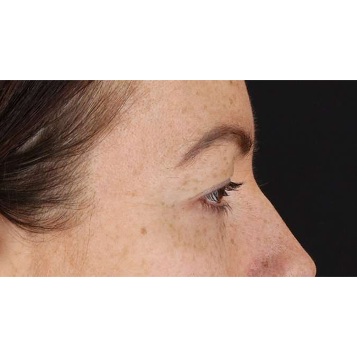 Blepharoplasty (Eyelid Surgery) Before & After Patient #10771