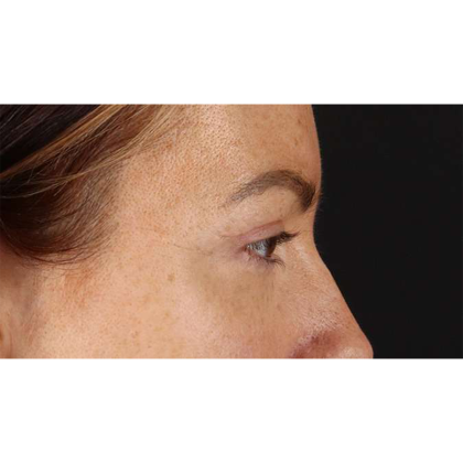 Blepharoplasty (Eyelid Surgery) Before & After Patient #10771