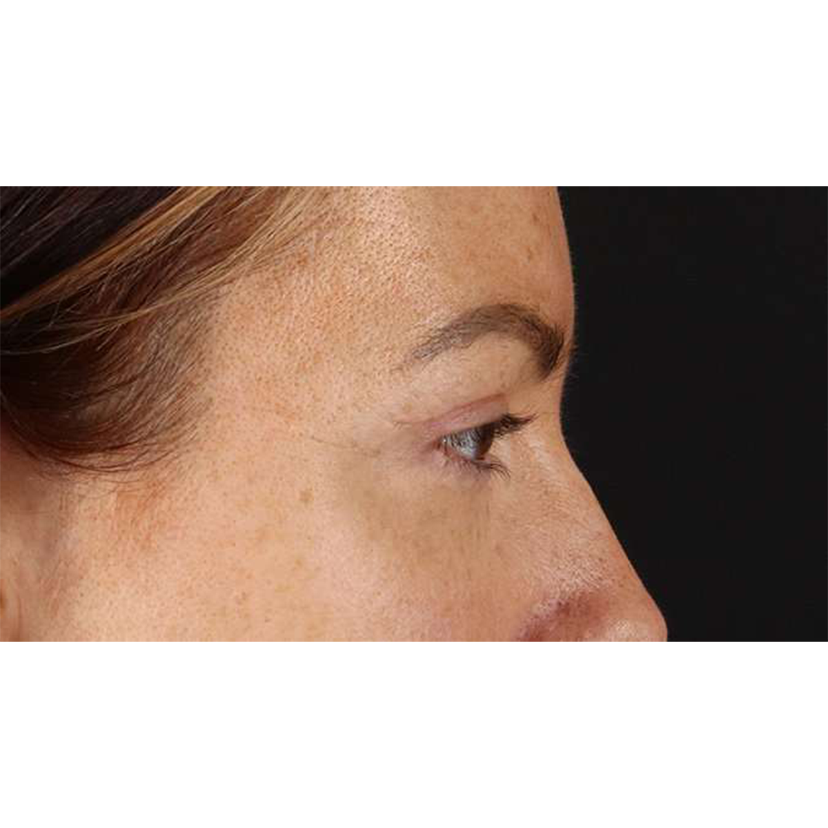 Blepharoplasty (Eyelid Surgery) Before & After Patient #10771