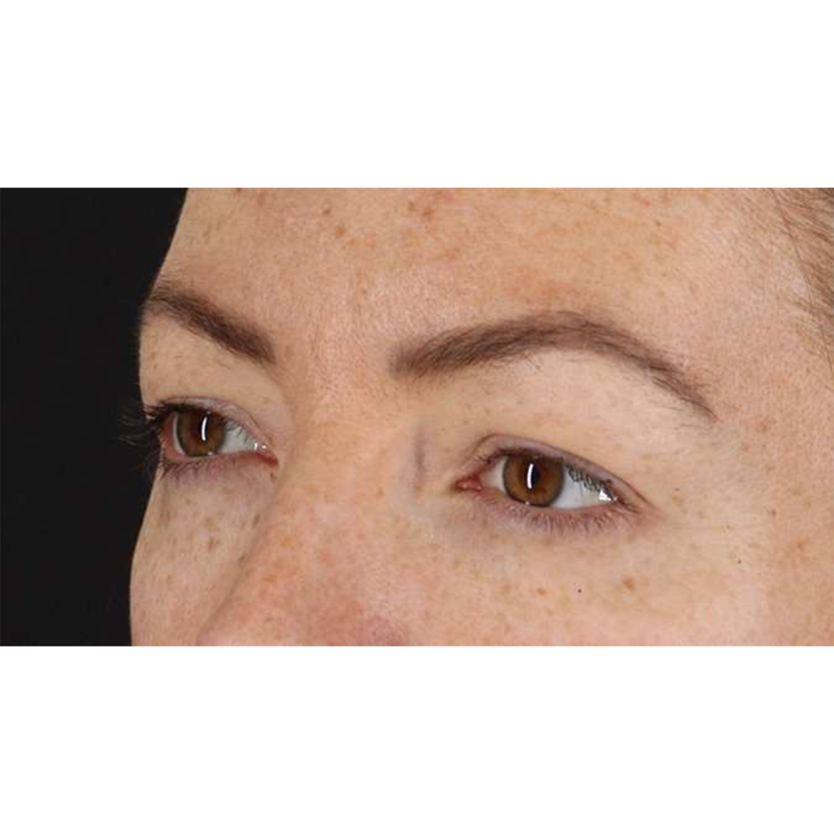 Blepharoplasty (Eyelid Surgery) Before & After Patient #10771