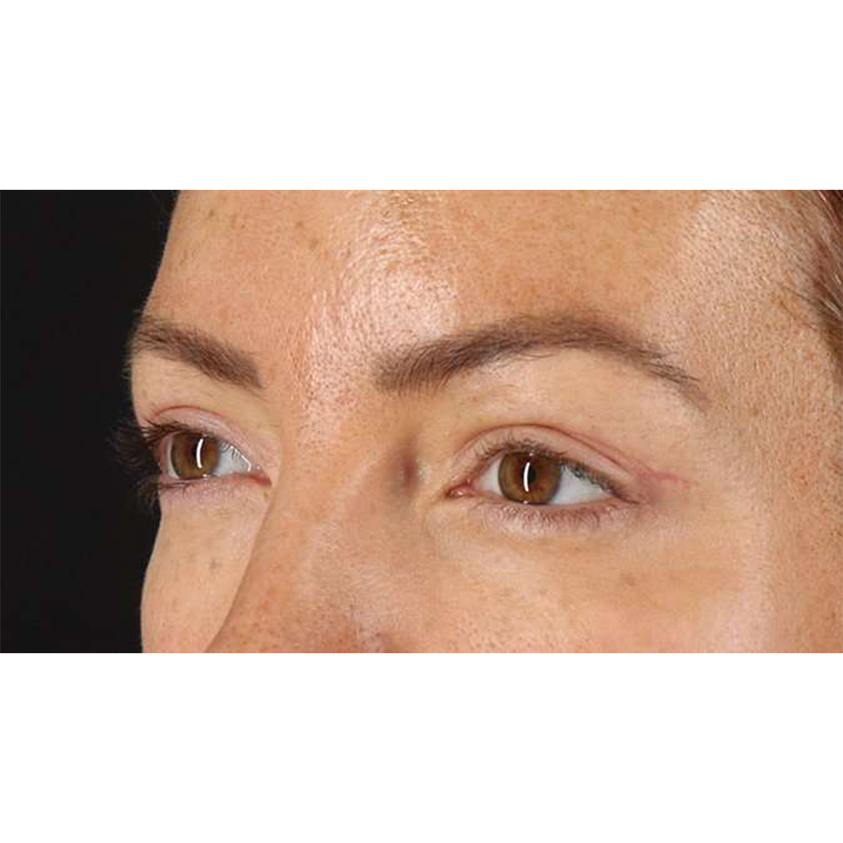 Blepharoplasty (Eyelid Surgery) Before & After Patient #10771