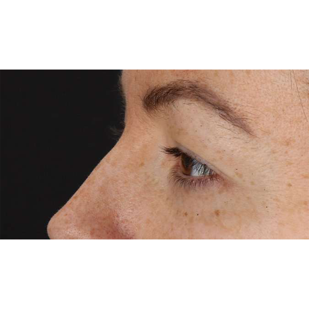 Blepharoplasty (Eyelid Surgery) Before & After Patient #10771