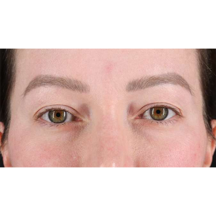Blepharoplasty (Eyelid Surgery) Before & After Patient #10606