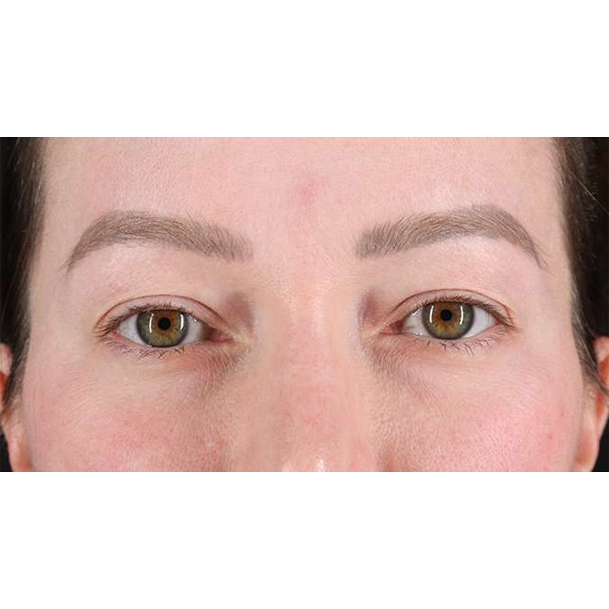 Blepharoplasty (Eyelid Surgery) Before & After Patient #10606