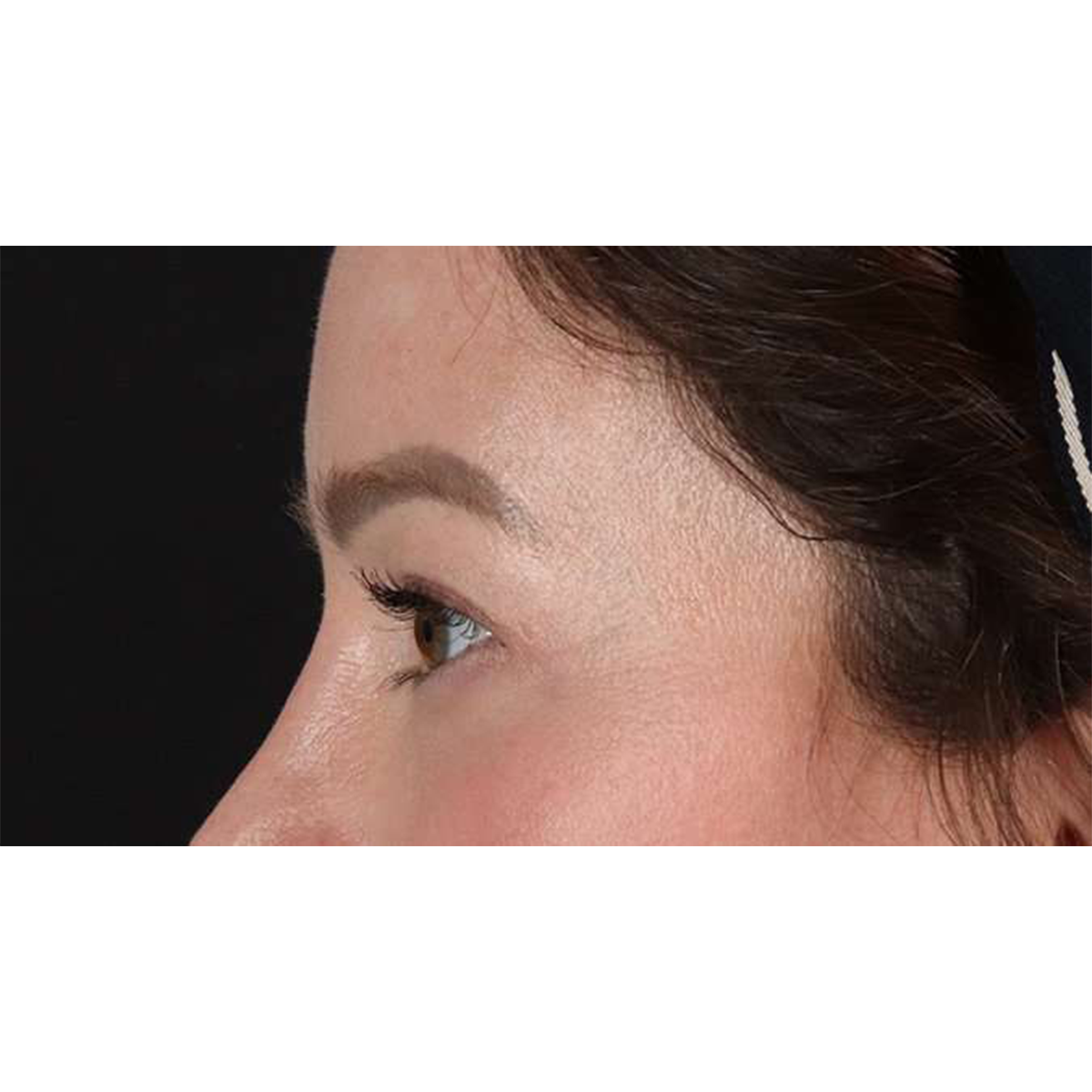 Blepharoplasty (Eyelid Surgery) Before & After Patient #10606