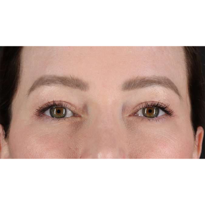 Blepharoplasty (Eyelid Surgery) Before & After Patient #10606