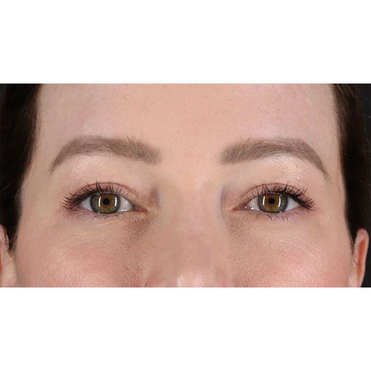 Blepharoplasty (Eyelid Surgery) Before & After Patient #10606