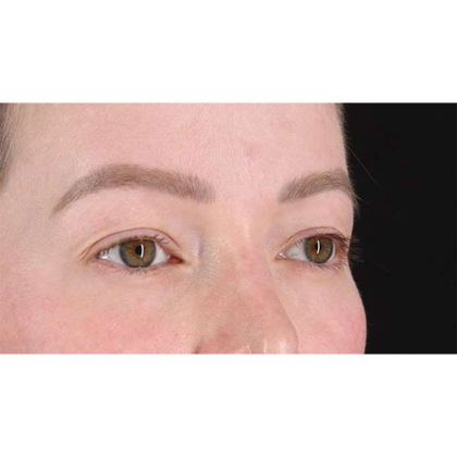 Blepharoplasty (Eyelid Surgery) Before & After Patient #10606