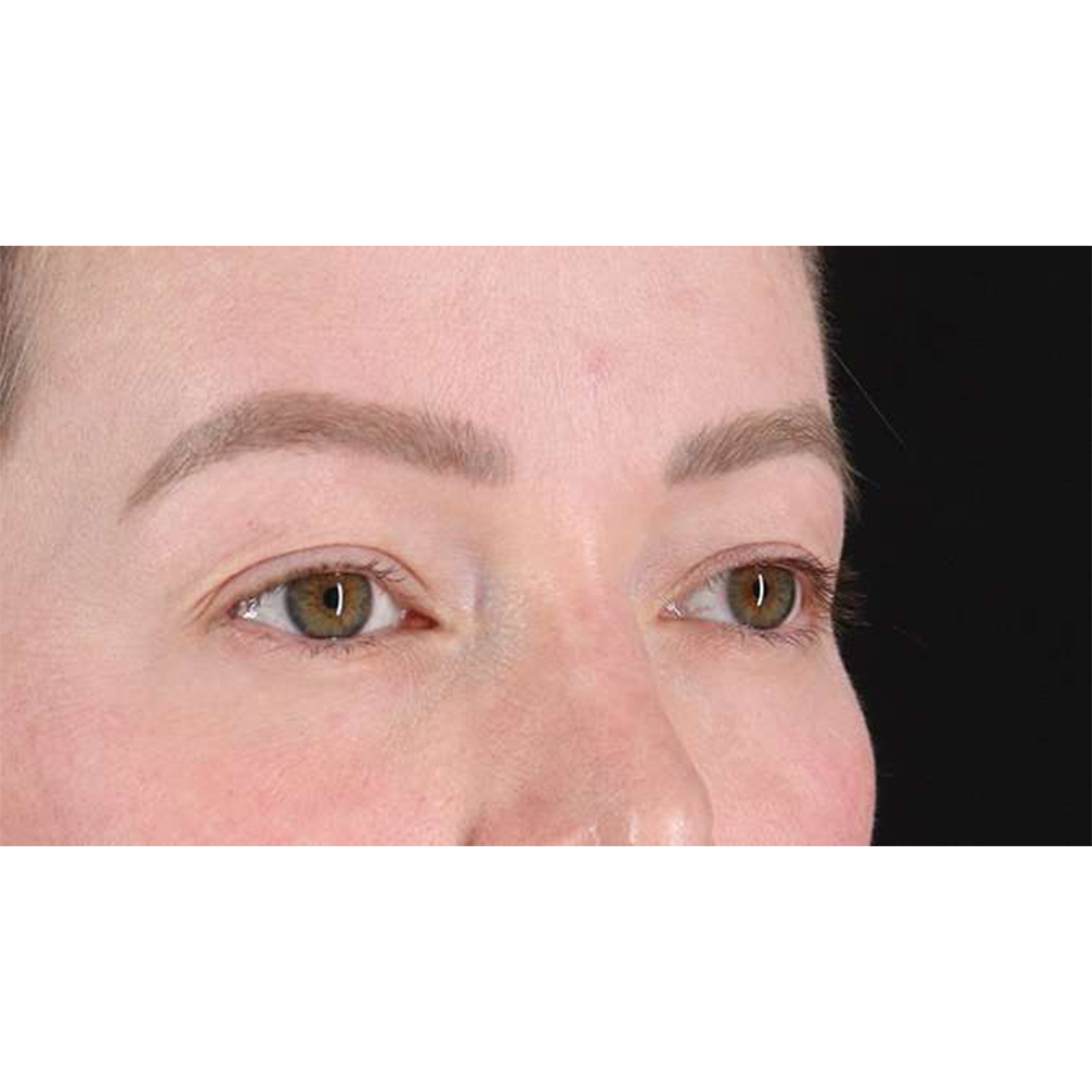 Blepharoplasty (Eyelid Surgery) Before & After Patient #10606
