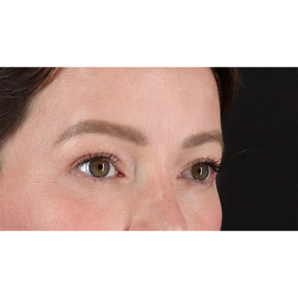 Blepharoplasty (Eyelid Surgery) Before & After Patient #10606