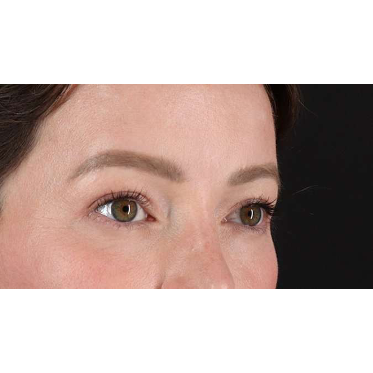 Blepharoplasty (Eyelid Surgery) Before & After Patient #10606