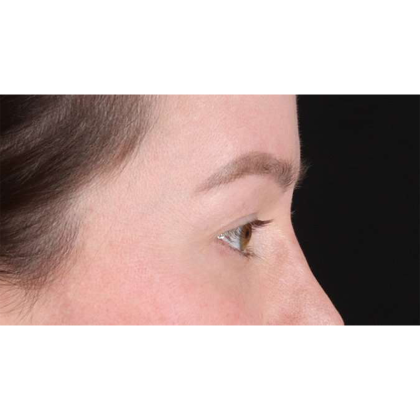 Blepharoplasty (Eyelid Surgery) Before & After Patient #10606