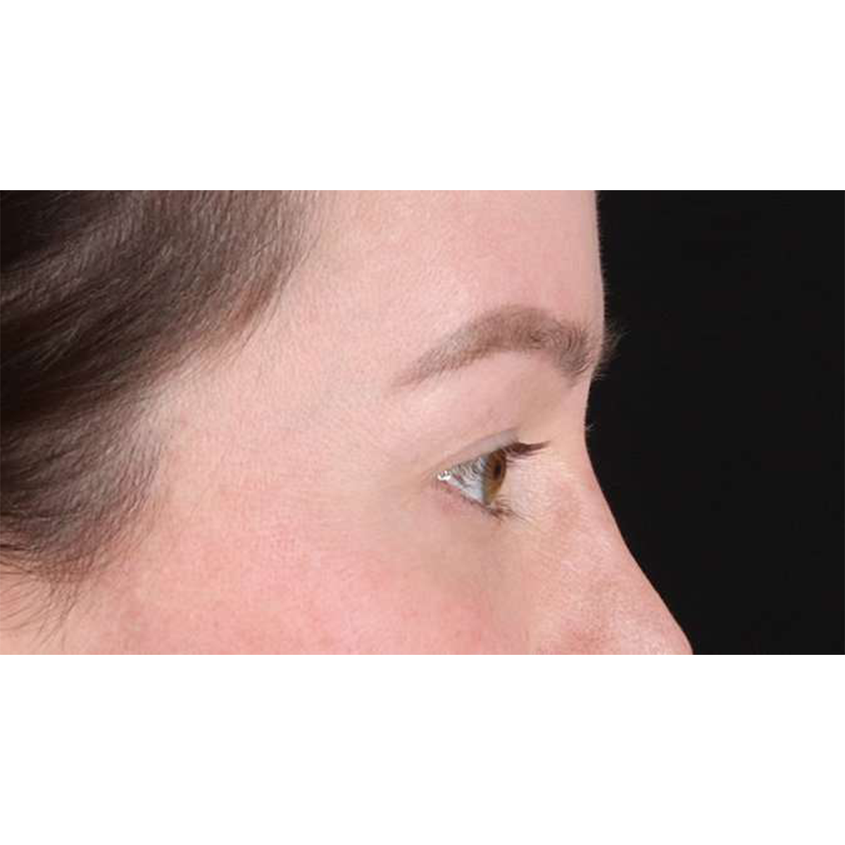 Blepharoplasty (Eyelid Surgery) Before & After Patient #10606