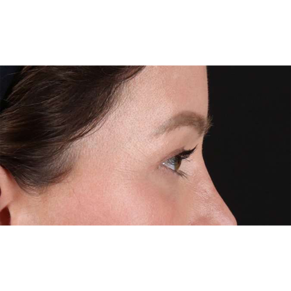 Blepharoplasty (Eyelid Surgery) Before & After Patient #10606