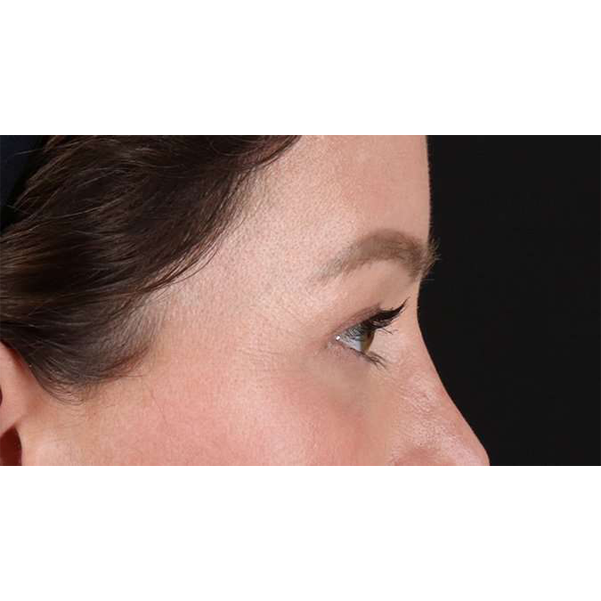 Blepharoplasty (Eyelid Surgery) Before & After Patient #10606