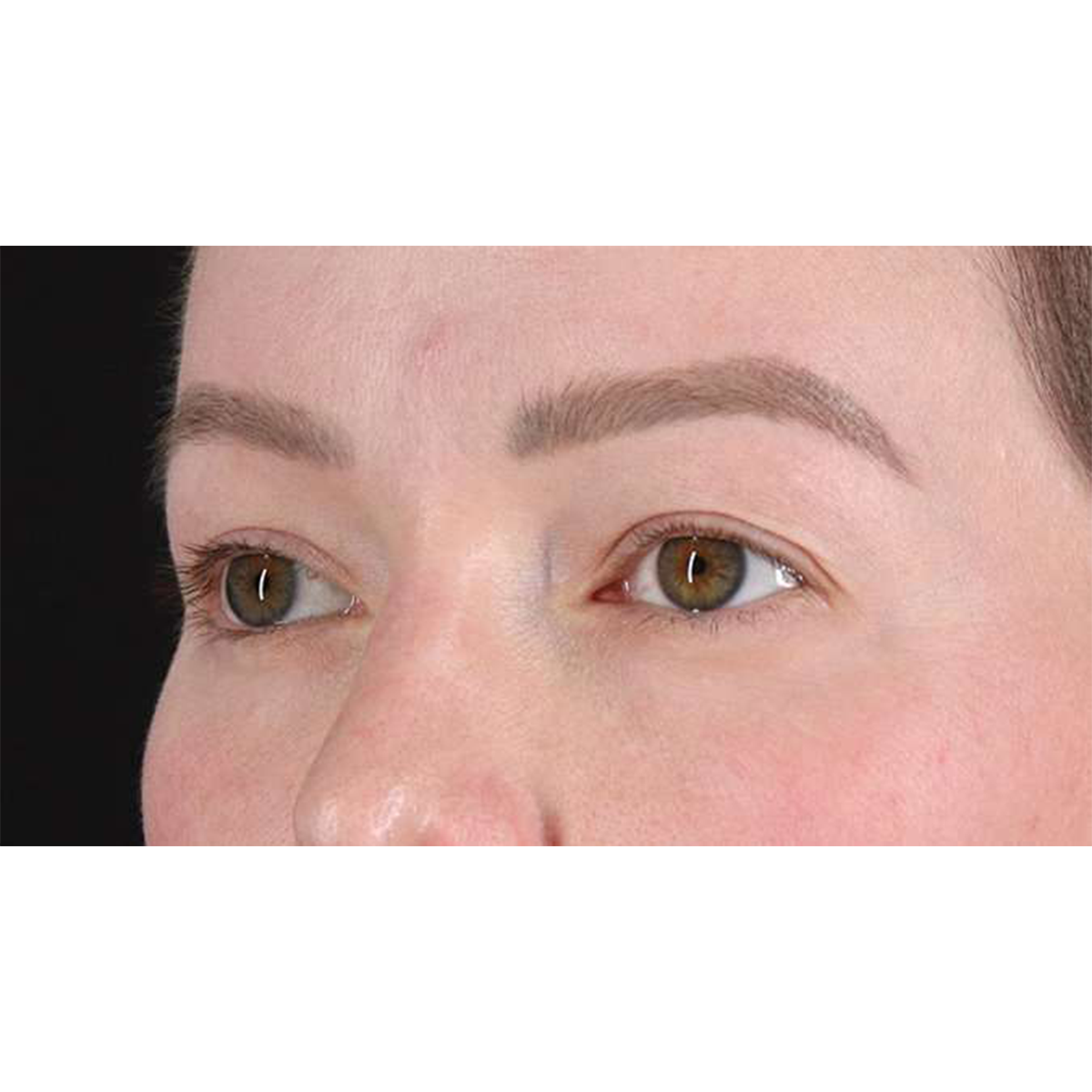 Blepharoplasty (Eyelid Surgery) Before & After Patient #10606