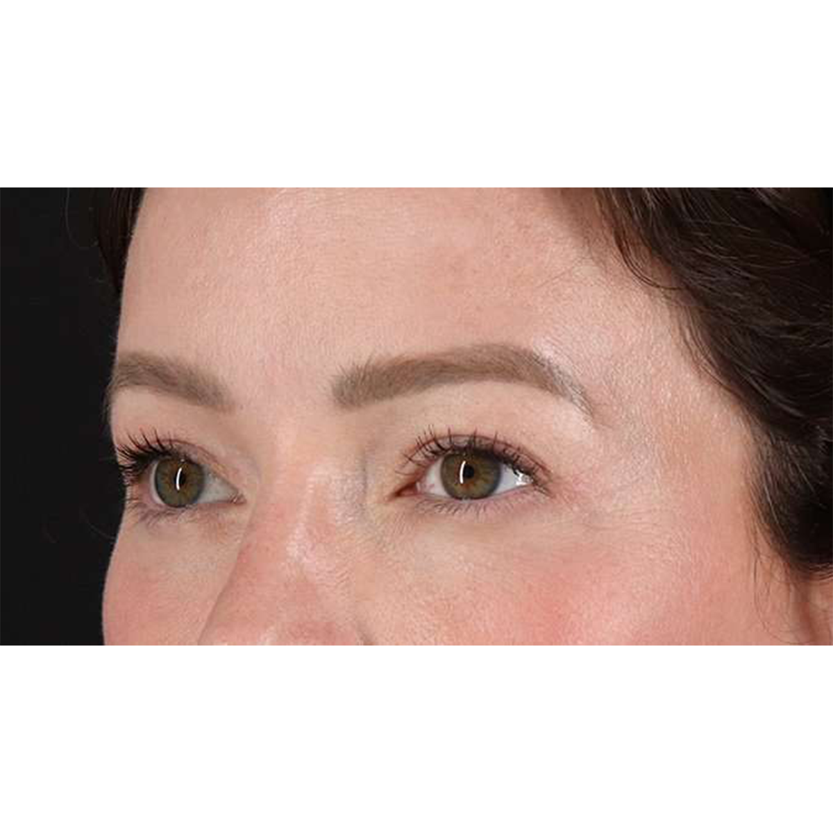 Blepharoplasty (Eyelid Surgery) Before & After Patient #10606