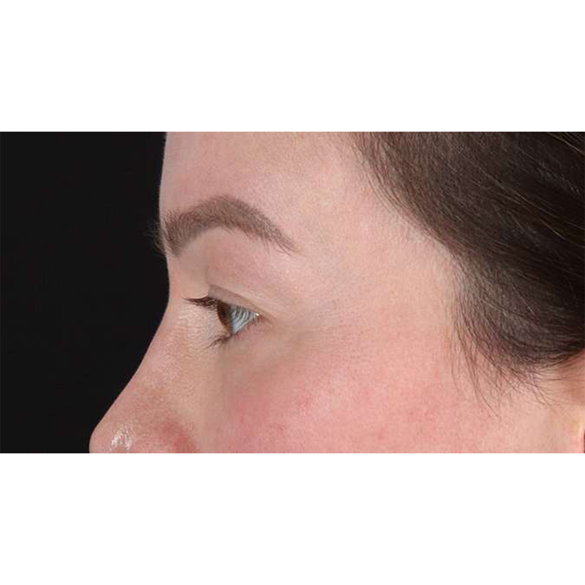 Blepharoplasty (Eyelid Surgery) Before & After Patient #10606
