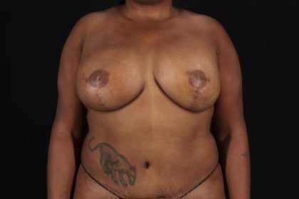 DIEP Flap Before & After Patient #9975