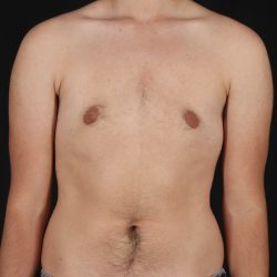 Female To Male Breast Before & After Patient #9981