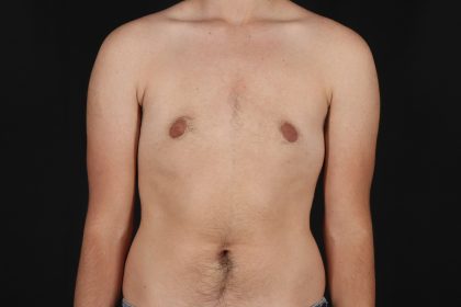 Female To Male Breast Before & After Patient #9981