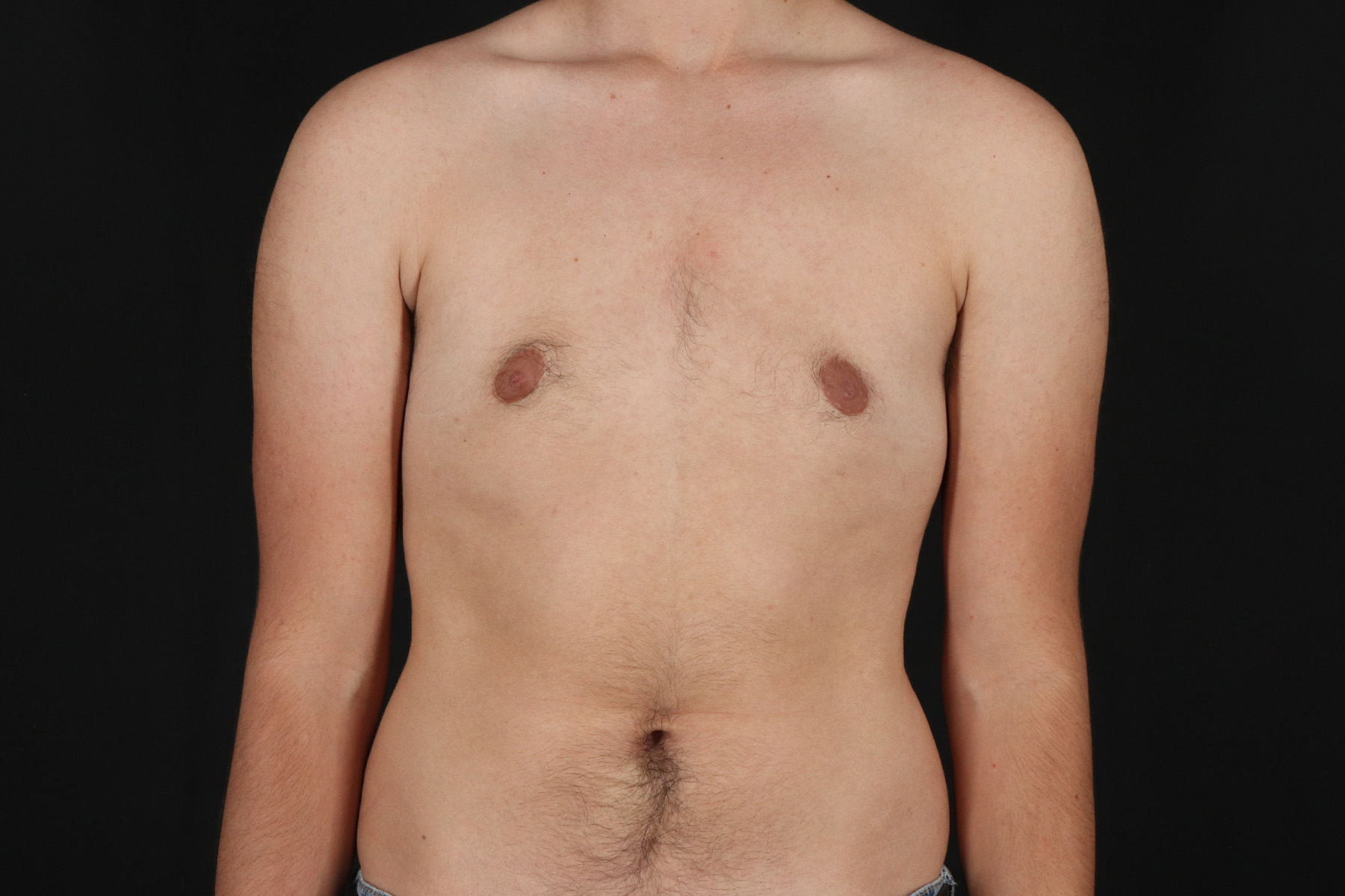 Female To Male Breast Before & After Patient #9981