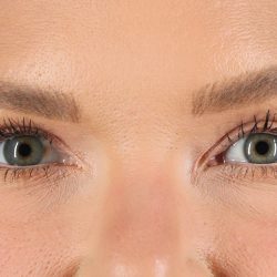 Blepharoplasty (Eyelid Surgery) Before & After Patient #9979