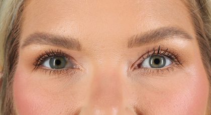 Blepharoplasty (Eyelid Surgery) Before & After Patient #9979