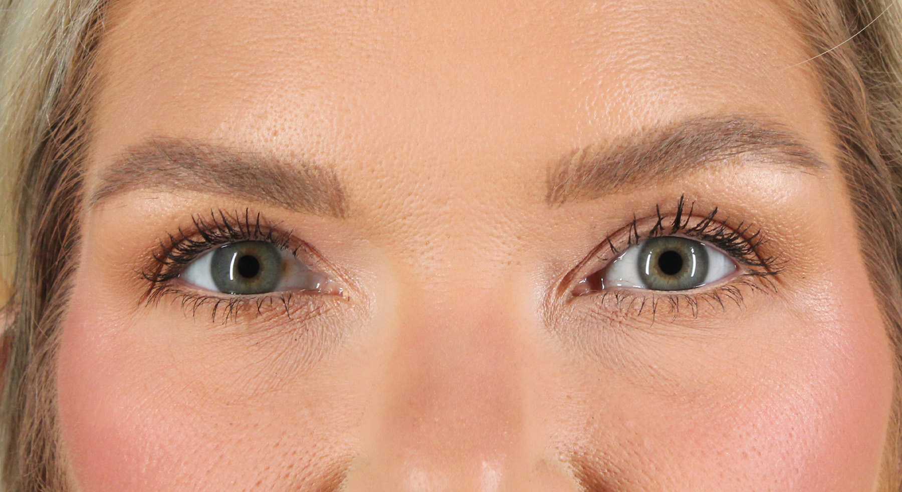 Blepharoplasty (Eyelid Surgery) Before & After Patient #9979
