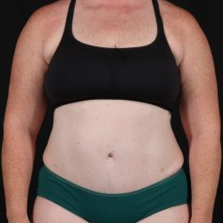 Abdominoplasty (Tummy Tuck) Before & After Patient #9980
