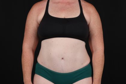 Abdominoplasty (Tummy Tuck) Before & After Patient #9980