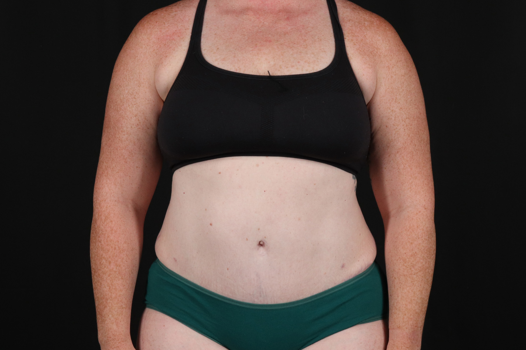 Abdominoplasty (Tummy Tuck) Before & After Patient #9980
