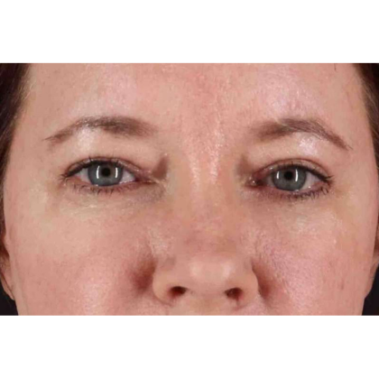 Brow Lift Before & After Patient #10859