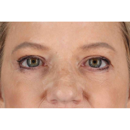 Brow Lift Before & After Patient #10848