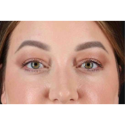 Brow Lift Before & After Patient #10837