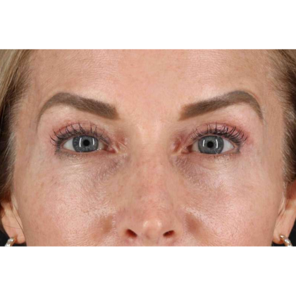 CO2 Laser Before & After Patient #10551