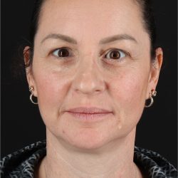 Chemical Peels Before & After Patient #11418