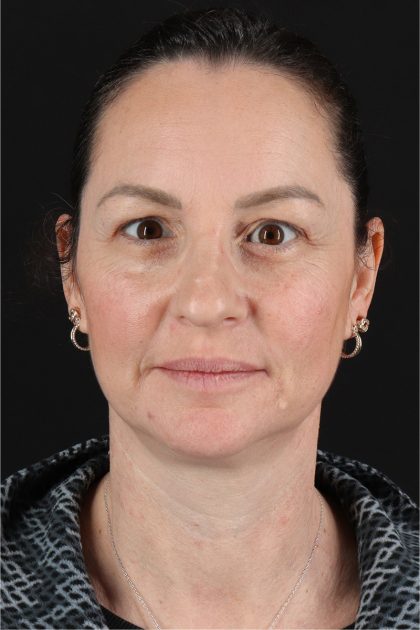 Chemical Peels Before & After Patient #11418