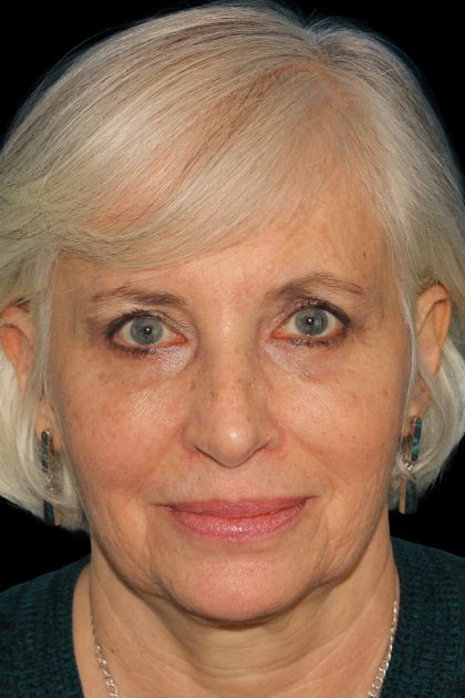 Upper Blepharoplasty Before & After Patient #11996