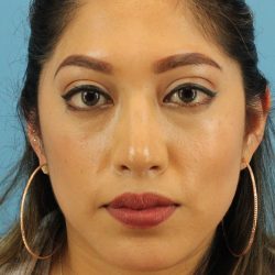 Chin Implant Before & After Patient #13673