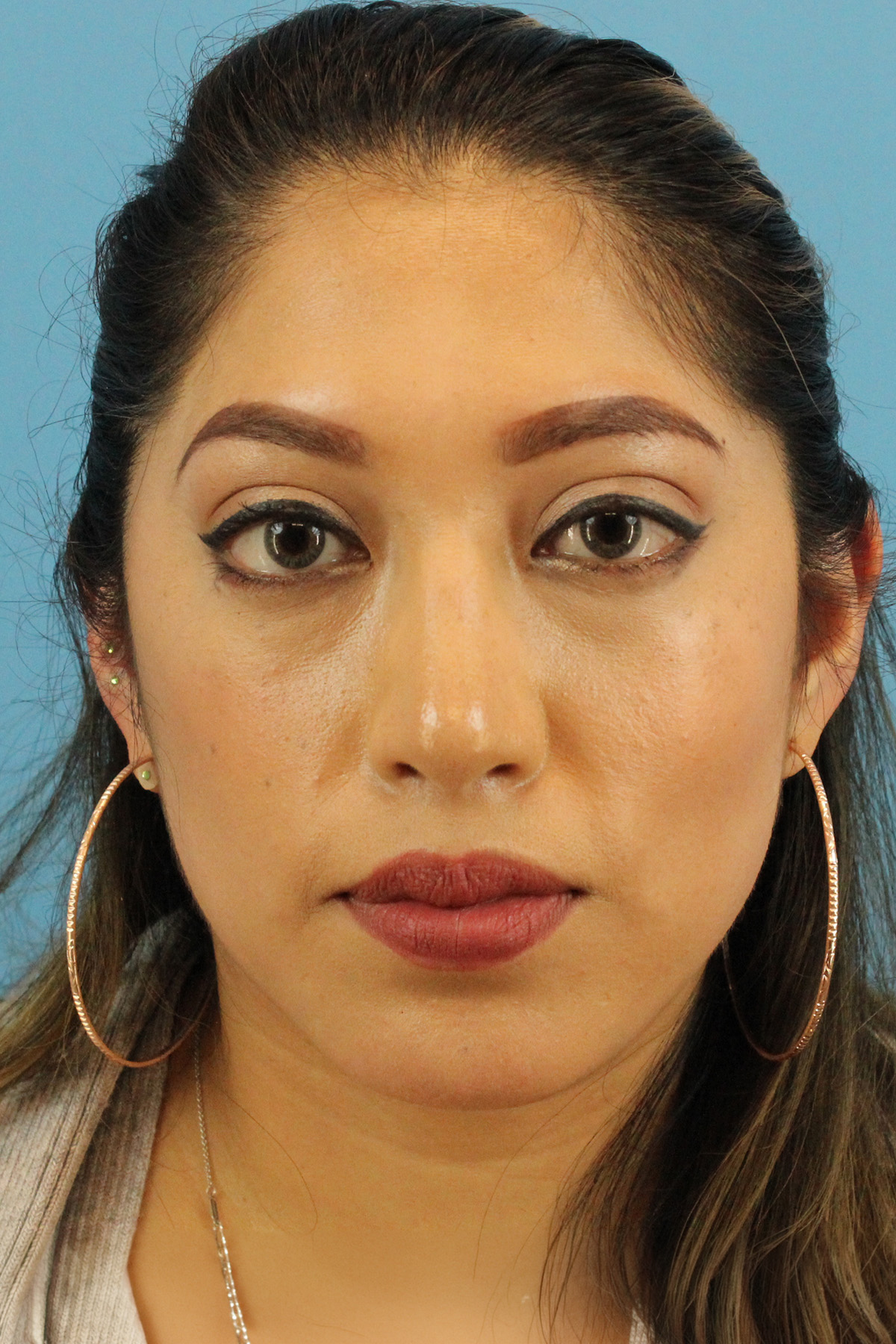 Chin Implant Before & After Patient #13673