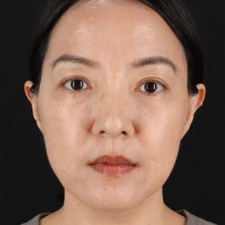 CO2 Laser Before & After Patient #11059