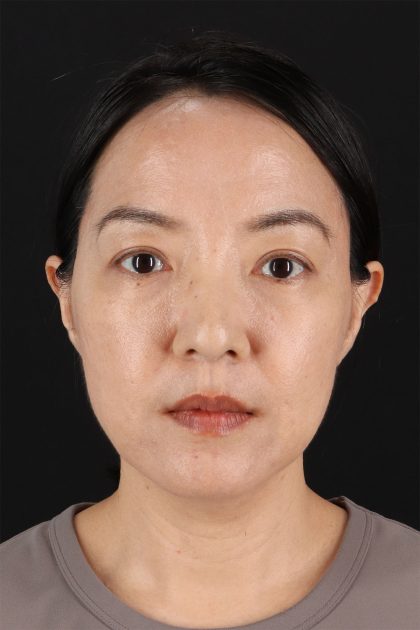 CO2 Laser Before & After Patient #11059