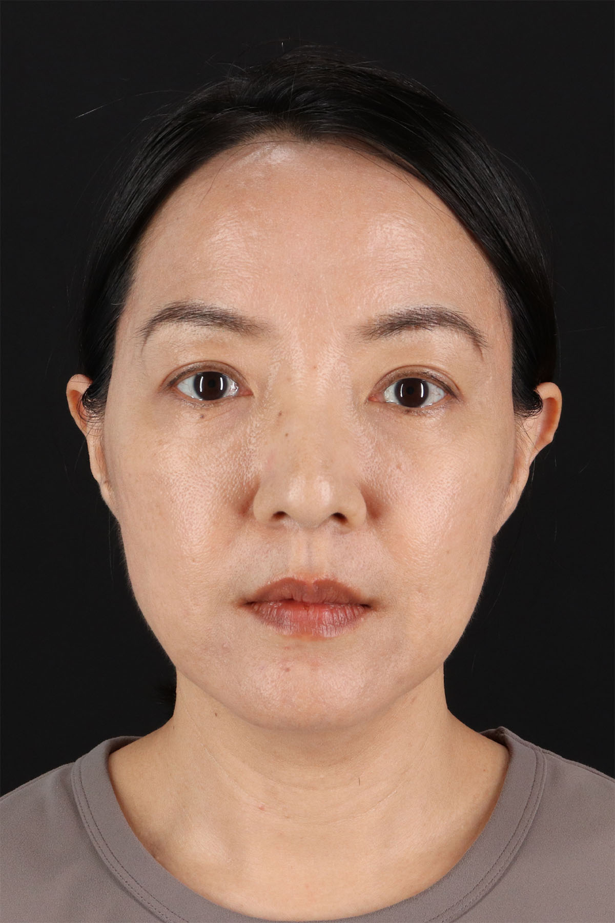 CO2 Laser Before & After Patient #11059