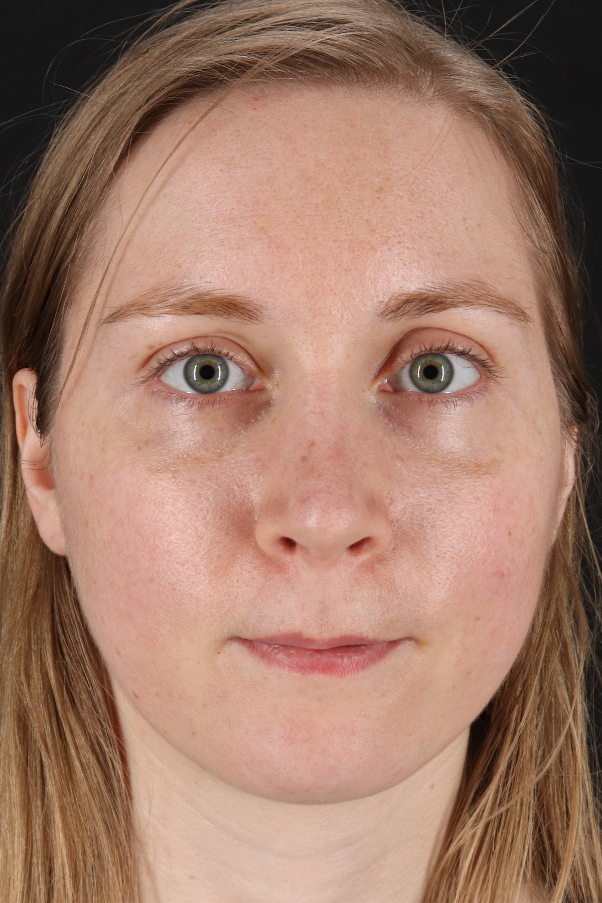 Rhinoplasty Before & After Patient #12238